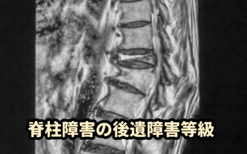脊柱変形障害・運動障害の後遺障害等級と認定基準